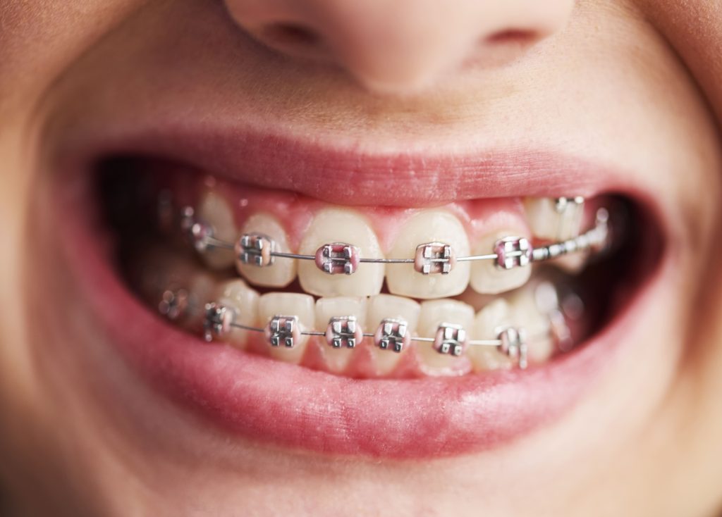 Paciente de la clinica dental Cardenal quiroga colocandose las gomillas de los brackets