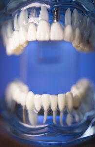 dentadura con implantes all on four en la clinica dental cardenal Quiroga