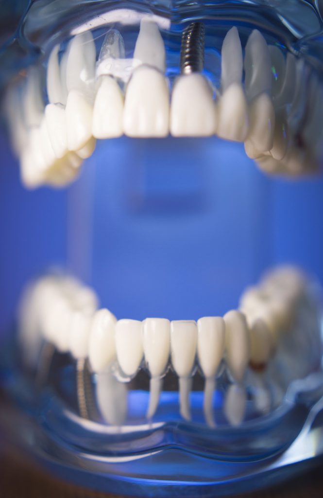dentadura con implantes all on four en la clinica dental cardenal Quiroga